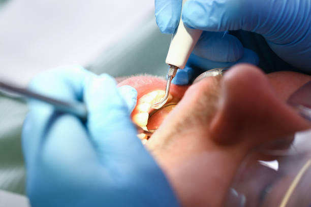 Best Emergency Tooth Extraction in Long Grove, IL